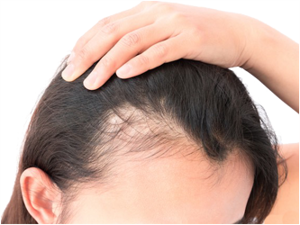 Saç Dökülmesi Mezoterapi Tedavisi